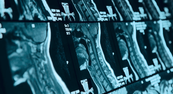 An MRI scan of a side view of a head and neck.